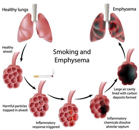 emphysema causes signs symptoms stages expectancy and treatment