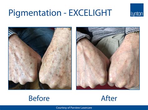 Pigmentation Jh Skincare Clinic Ipl Laser And Dermalux For Redness