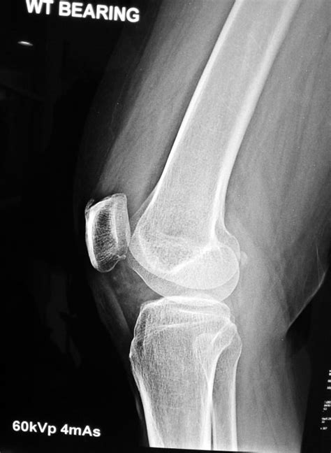 Avascular Necrosis Of The Knee Joint Dr Hc Chang