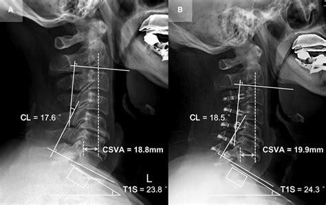 Frontiers Changes In T1 Slope And Cervical Sagittal Vertical Axis
