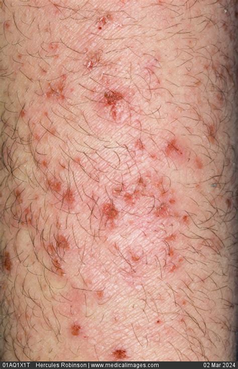 Stock Image Dermatology Infected Eczema A Widespread Vesicular Rash With Surrounding
