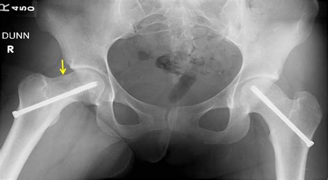 Hip Arthroscopy St Louis Mo Failed Total Hip Replacement