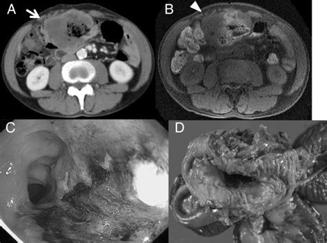 Tumor Mass Surrounded The Transverse Colon In The Epigastric Region A