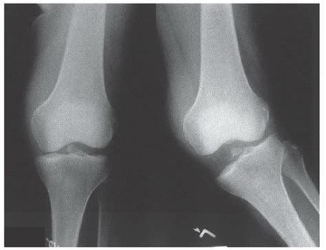 Medial Collateral Ligament Sprain Musculoskeletal Key