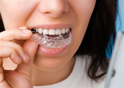 Invisalign Vs Braces Whats The Difference Town House Dental