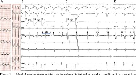 Figure 1 From Atypical Slow Slow Atrioventricular Nodal Reentrant Tachycardia With Use Of A