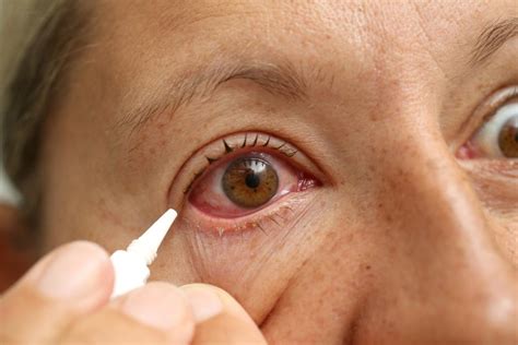 Red Eyes Home Remedies And Health Tips