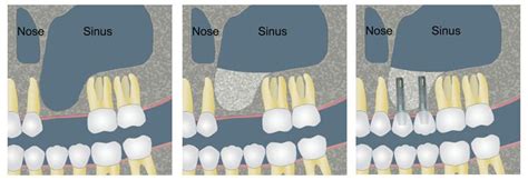 Sinus Lift Dental Procedures Dental Artistry Auckland