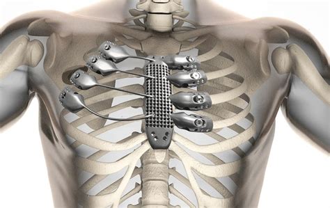 The front plane is composed of the sternum and. 3D Printing Gives Cancer Patient New Ribs and Sternum in ...