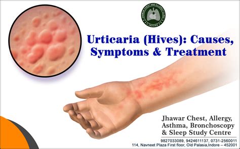 Hives Urticaria Causes Pictures Symptoms And Treatmen