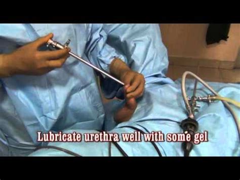 Bipolar Turp How To Dilate The Urethra And Insert The Resectoscope Sheath Youtube
