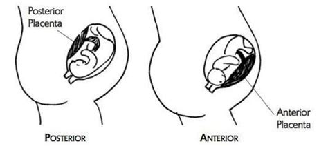 Anterior Placenta Risks Complications Symptoms Causes