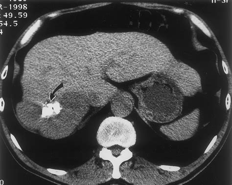 Hepatic Adenomas Imaging And Pathologic Findings Radiographics