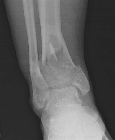 Case Of The Month Fracture Cases At Harborview Medical Center