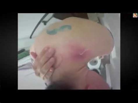 Because popping isn't the way to go, patience is the key. Biggest Zit Cyst Pop Ever!! Most Amazing Pops Best back ...