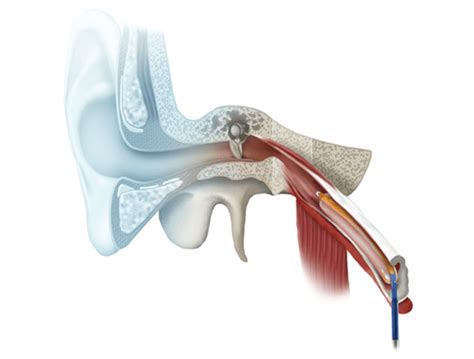 Eustachian tube balloon dilation patient information and informed surgical consent the eustachian tube (et) connects the middle ear to the back of the nose and throat, in the nasopharynx. What Is Eustachian Tube Dysfunction? | sinussurgeryoptions.com