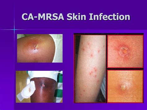 Ppt Working In A Cms Know The Facts About Community Associated Mrsa