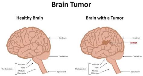 Brain Tumour Health Tips Brain Tumour Health Articles Health News