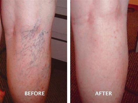 Cosmetic Sclerotherapy For Spider Veins Advanced Vein Therapy