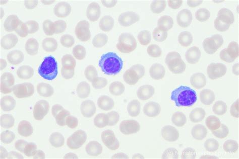 Plasma Cell Leukemia Pcl Hematomorphology A Databank