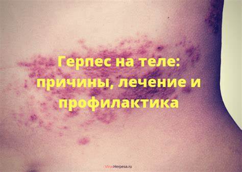 Лечение герпеса диета