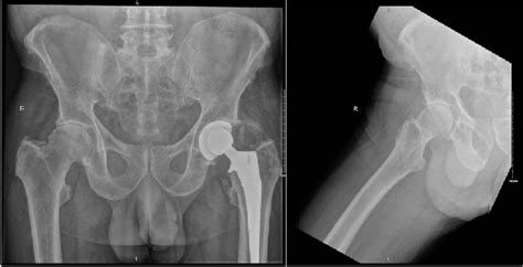 Preoperative Ap Pelvis And Lateral Right Hip Radiographs Of Our Patient