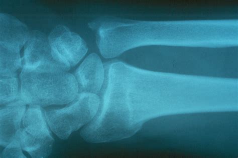 Reconstruction Ulnar Shortening Osteotomy For Distal Radius Fracture