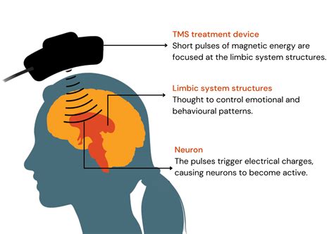 Tms Therapy For Anxiety Near Me Alethea Mcfarland