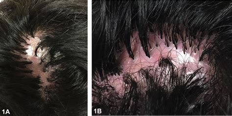 Tufts Of “dolls Hair” Within A Shiny Scarring Alopecia Journal Of