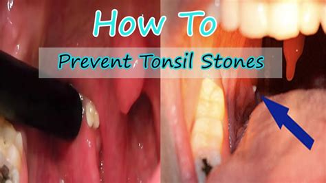 How To Prevent Tonsil Stones And Why They Cause Bad Breath Youtube