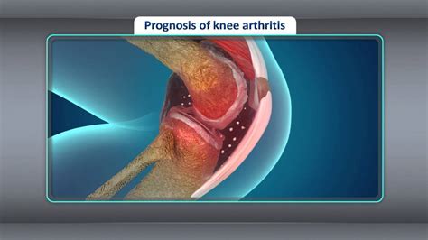Treatment Treatment For Osteoarthritis Of The Knee Youtube