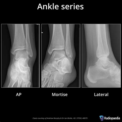 The Ankle Radiograph Sinai Em