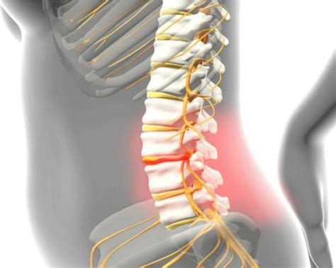 Como Saber Se Tenho H Rnia De Disco Itc Vertebral