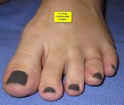 Part Ii British Hammertoes Are “wonky Toes” Before And After Pictures Of Hammertoe Surgery