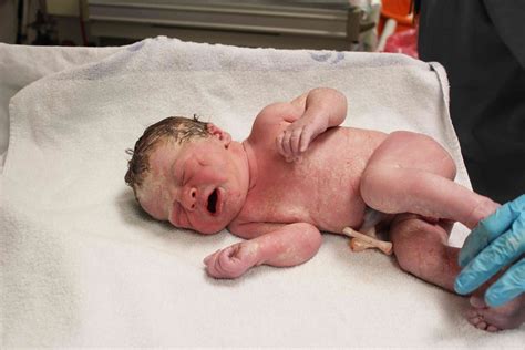 Most Common Injuries To Newborns During Birth
