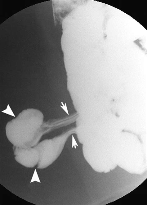 Anterior Abdominal Wall Hernias Findings In Barium Studies Radiographics