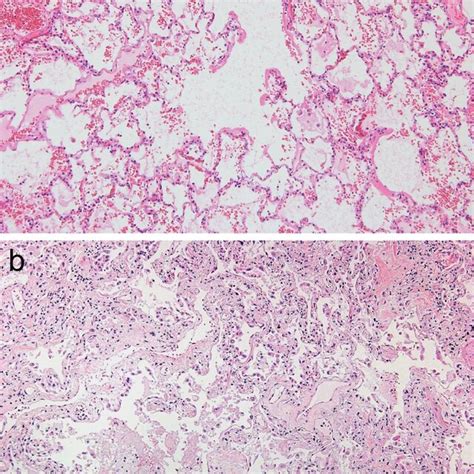 Histopathology Of Autopsy Specimens Of The Acute Phase A And The