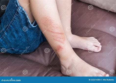 Wounds Scratches And Abrasions On Skin Of Child Leg Children Injury