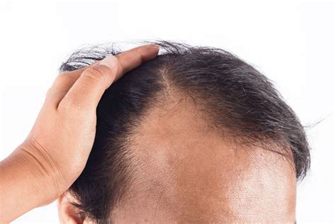 Bald Spot On The Back Of Head How To Prevent And Treat Hair Loss