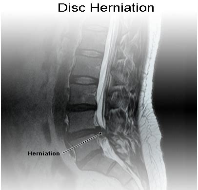 The spine surgeons at the. Slipped Disc,India Slipped Disc Surgery,India Cost Spinal Disc Surgery