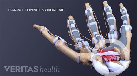 All About Carpal Tunnel Release Surgery