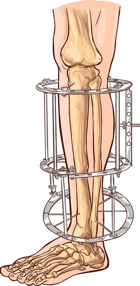 Fracture Care Treatment When Is A Cast Not Good Enough