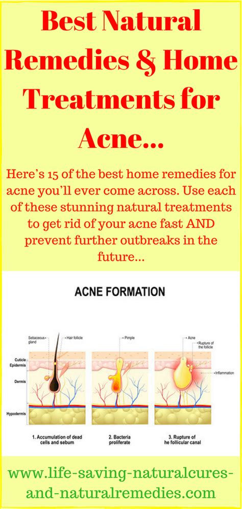 Best Fast Acting Natural Remedies For Acne Get Clear Skin And No