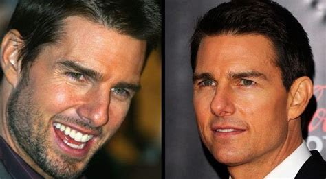 Tom Cruise Plastic Surgery Before And After Even His Age Now Over The