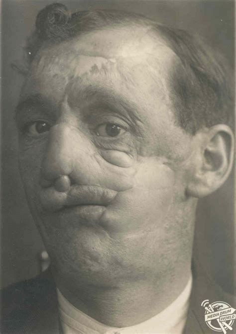 Fascinating Photos Of Injured British Soldiers From Wwi