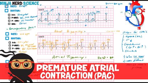 Rate And Rhythm Premature Atrial Contraction Pac Youtube