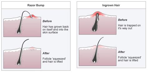 The Best And Only Ways To Avoid Razor Bumps
