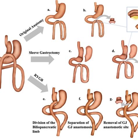 Causes And Management Of Revisions After One Anastomosis Gastric Bypass