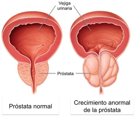 Crecimiento Prostático Dr Seiichi Fuziwara Ruiz Urólogo En Cdmx