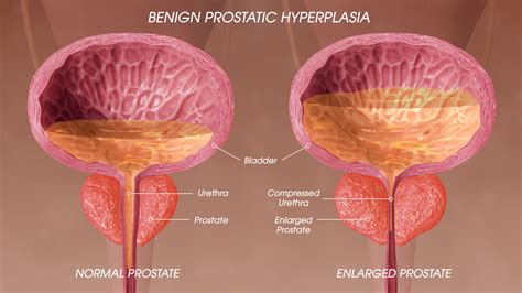 Benign Prostatic Hyperplasia Symptoms Causes And Treatment Scientific Animations